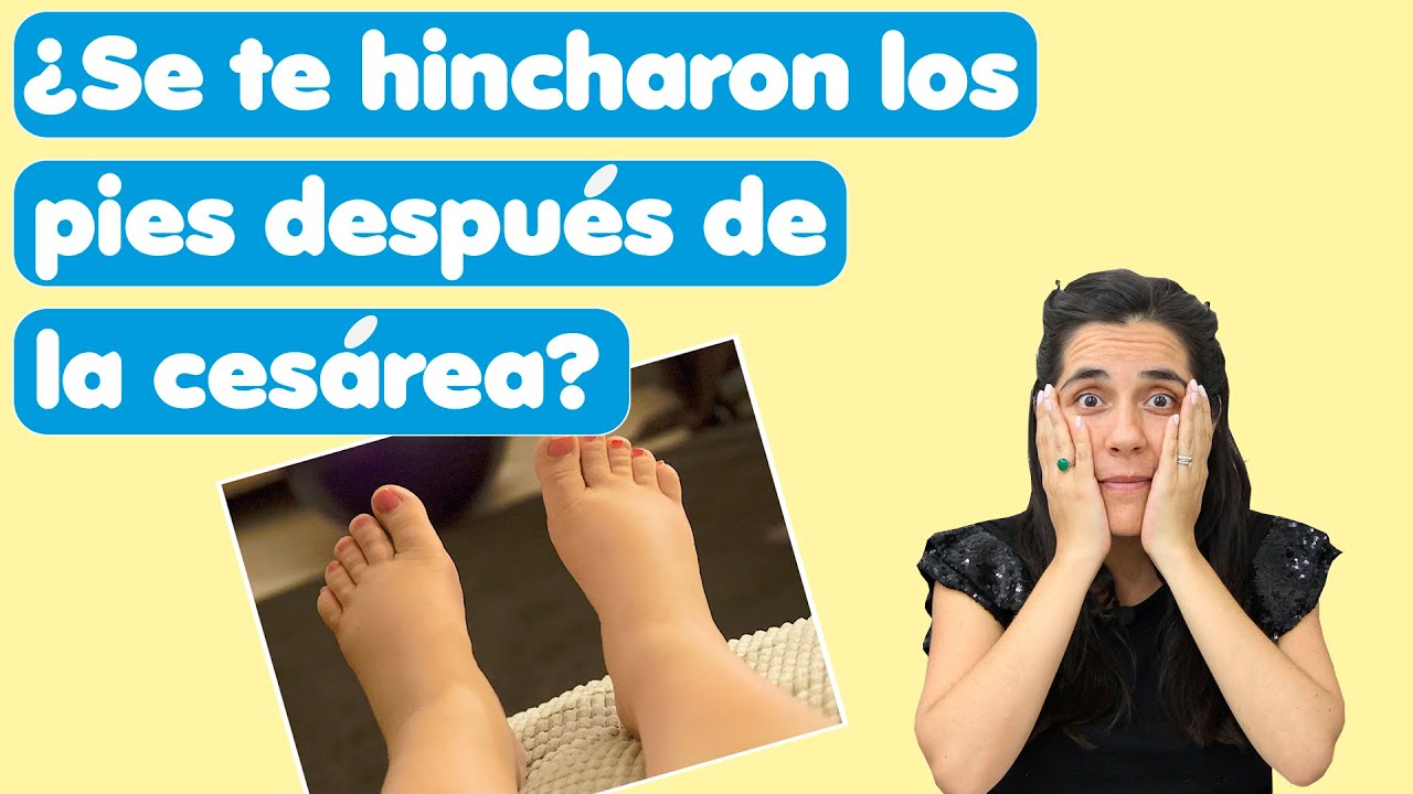 cómo desinflamar los pies después de una cesárea
