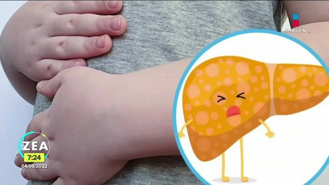 problemas de higado en niños sintomas